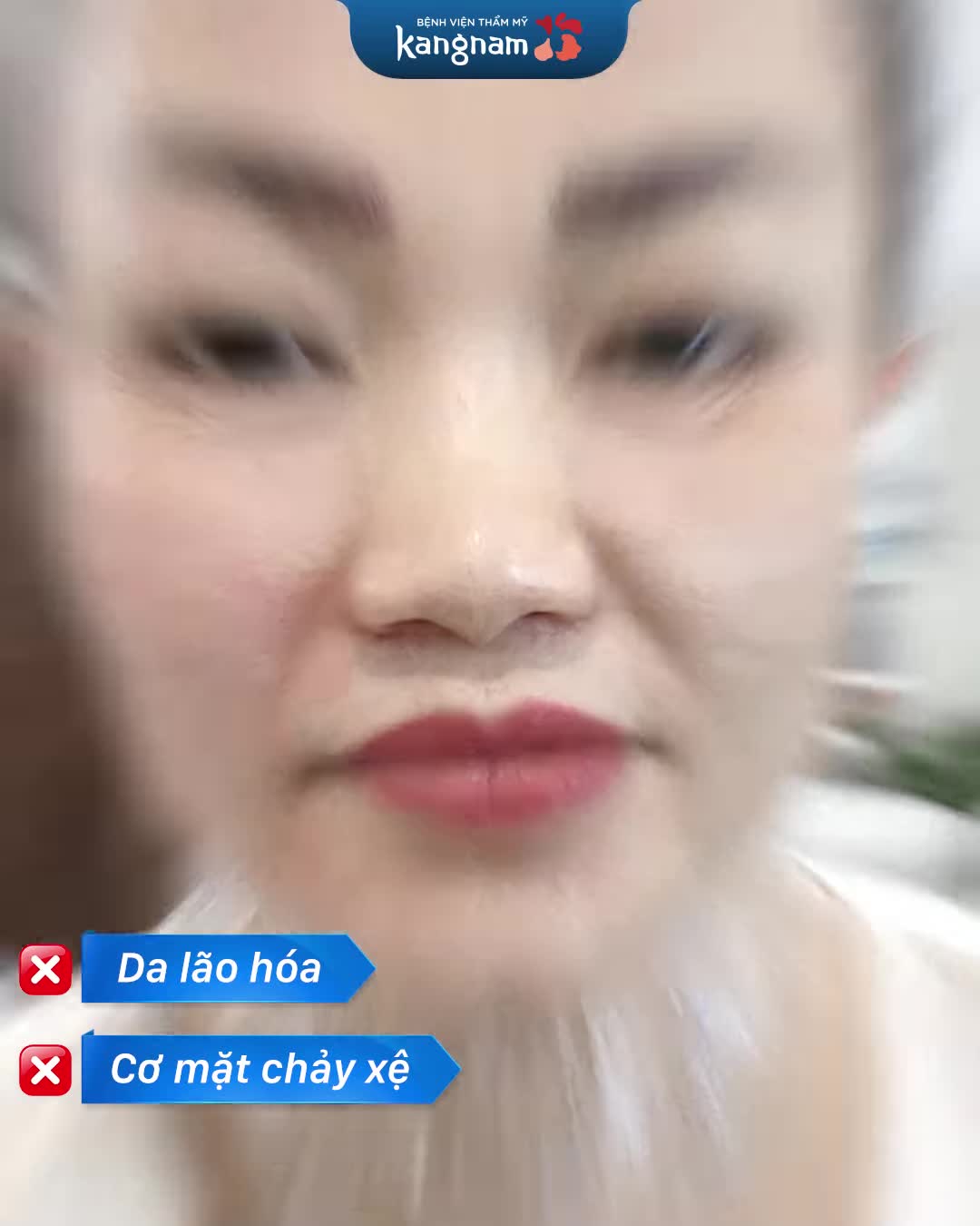 TRẺ HÓA THERMAGE - FLX TRÚNG MERCEDES